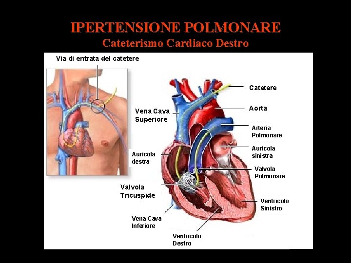 IPERTENSIONE POLMONARE Cateterismo Cardiaco Destro Via di entrata del catetere Catetere Aorta Vena Cava