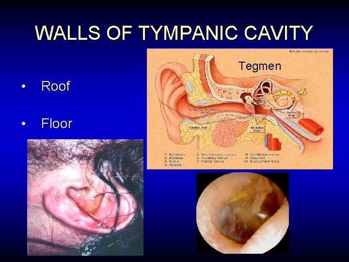 WALLS OF TYMPANIC CAVITY Tegmen • Roof • Floor 