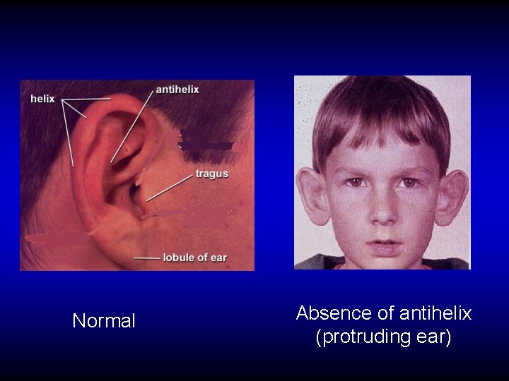 Normal Absence of antihelix (protruding ear) 