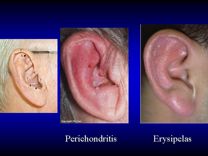 Perichondritis Erysipelas 