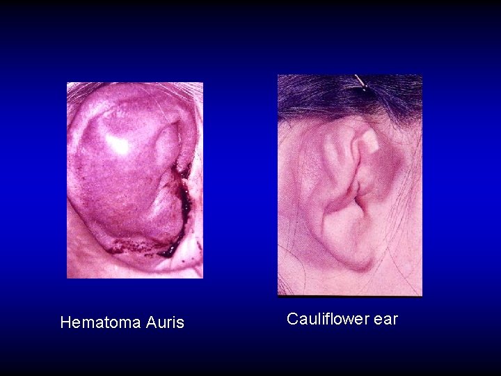 Hematoma Auris Cauliflower ear 