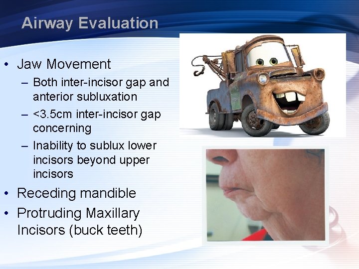 Airway Evaluation • Jaw Movement – Both inter-incisor gap and anterior subluxation – <3.