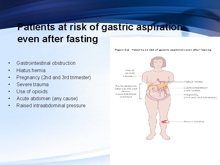 Patients at risk of gastric aspiration even after fasting • • Gastrointestinal obstruction Hiatus
