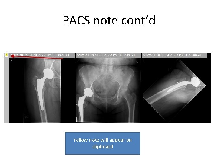 PACS note cont’d Yellow note will appear on clipboard 