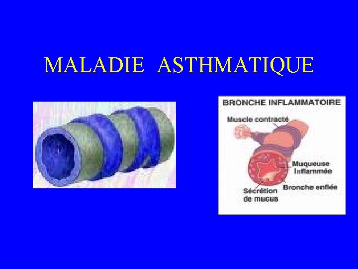 MALADIE ASTHMATIQUE 