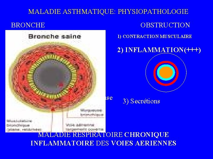  MALADIE ASTHMATIQUE: PHYSIOPATHOLOGIE BRONCHE NX OBSTRUCTION muscle muqueuse 1) CONTRACTION MUSCULAIRE 2) INFLAMMATION(+++)