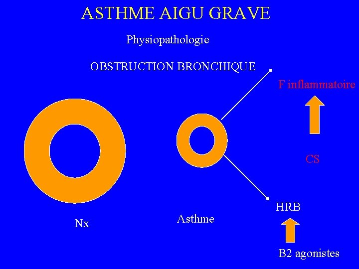 ASTHME AIGU GRAVE Physiopathologie OBSTRUCTION BRONCHIQUE F inflammatoire CS Nx Asthme HRB B 2