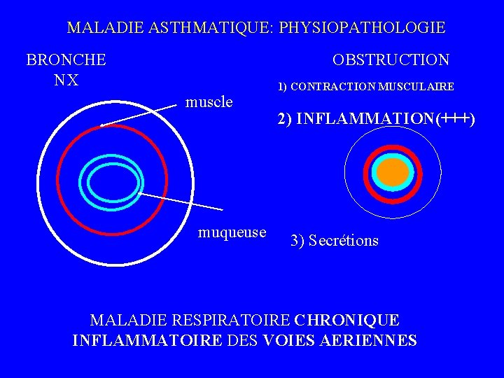  MALADIE ASTHMATIQUE: PHYSIOPATHOLOGIE BRONCHE NX OBSTRUCTION muscle muqueuse 1) CONTRACTION MUSCULAIRE 2) INFLAMMATION(+++)