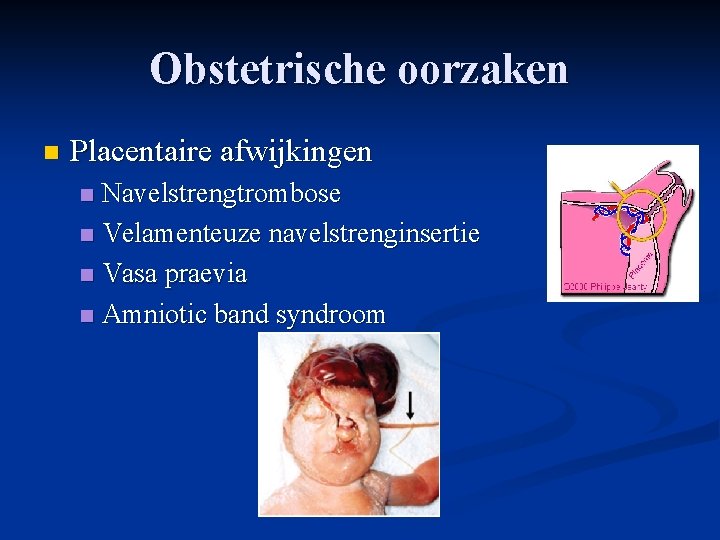 Obstetrische oorzaken n Placentaire afwijkingen Navelstrengtrombose n Velamenteuze navelstrenginsertie n Vasa praevia n Amniotic Obstetrische oorzaken n Placentaire afwijkingen Navelstrengtrombose n Velamenteuze navelstrenginsertie n Vasa praevia n Amniotic