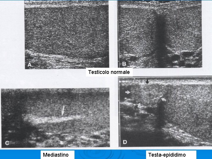 Testicolo normale Mediastino Testa-epididimo 