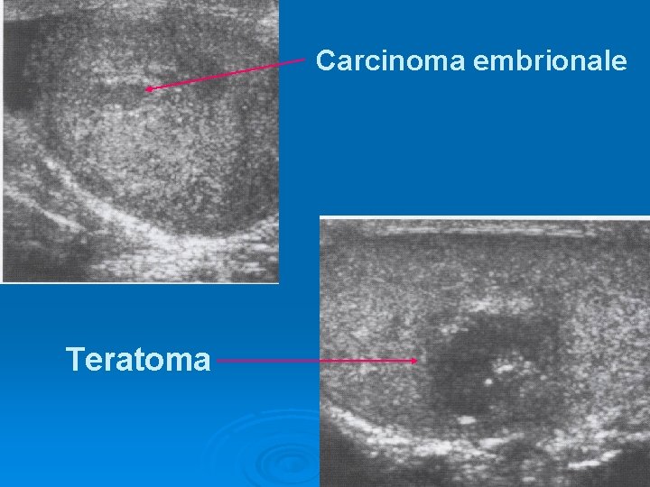 Carcinoma embrionale Teratoma 