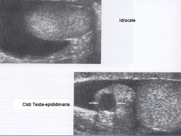 Idrocele Cisti Testa-epididimaria 