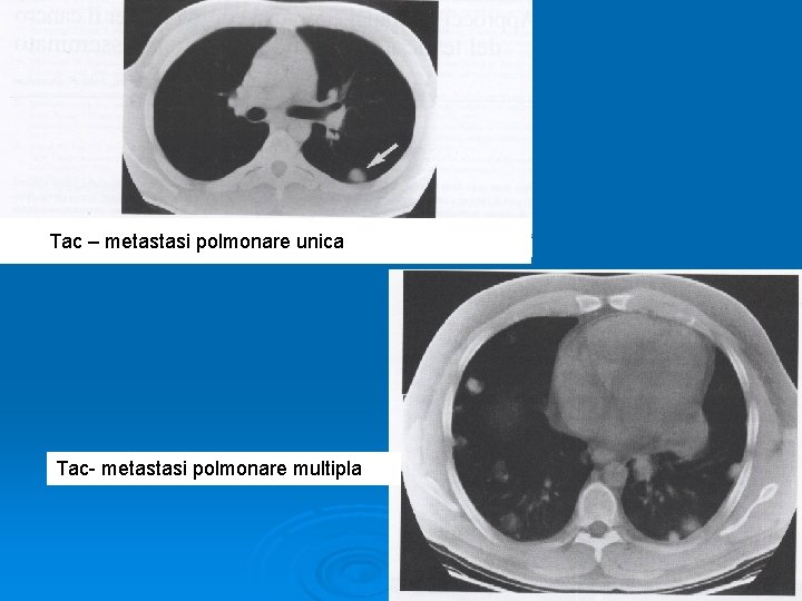 Tac – metastasi polmonare unica Tac- metastasi polmonare multipla 