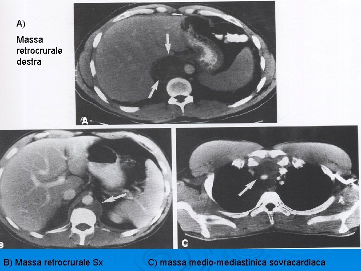 A) Massa retrocrurale destra A B B) Massa retrocrurale Sx C C) massa medio-mediastinica