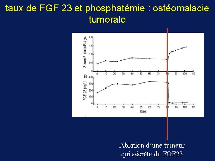 taux de FGF 23 et phosphatémie : ostéomalacie tumorale Ablation d’une tumeur qui sécrète