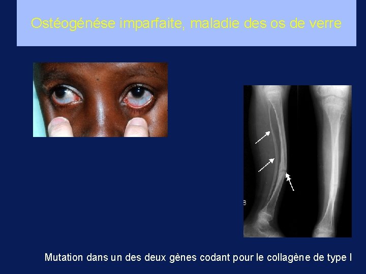 Ostéogénése imparfaite, maladie des os de verre Mutation dans un des deux gènes codant