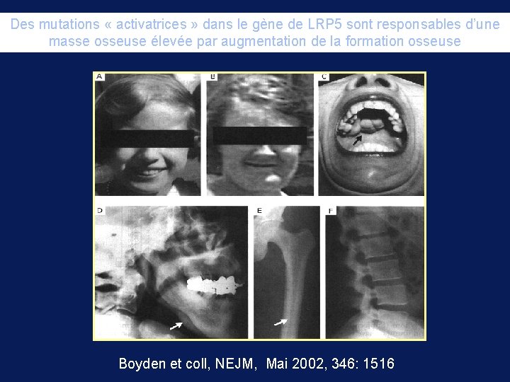 Des mutations « activatrices » dans le gène de LRP 5 sont responsables d’une