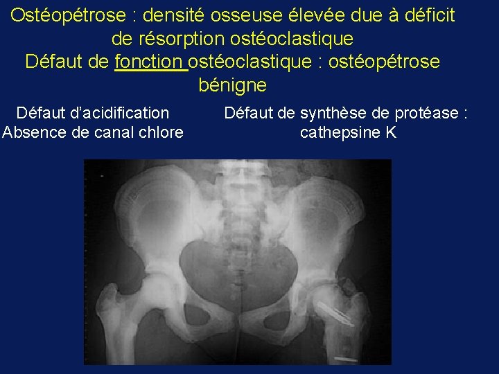 Ostéopétrose : densité osseuse élevée due à déficit de résorption ostéoclastique Défaut de fonction