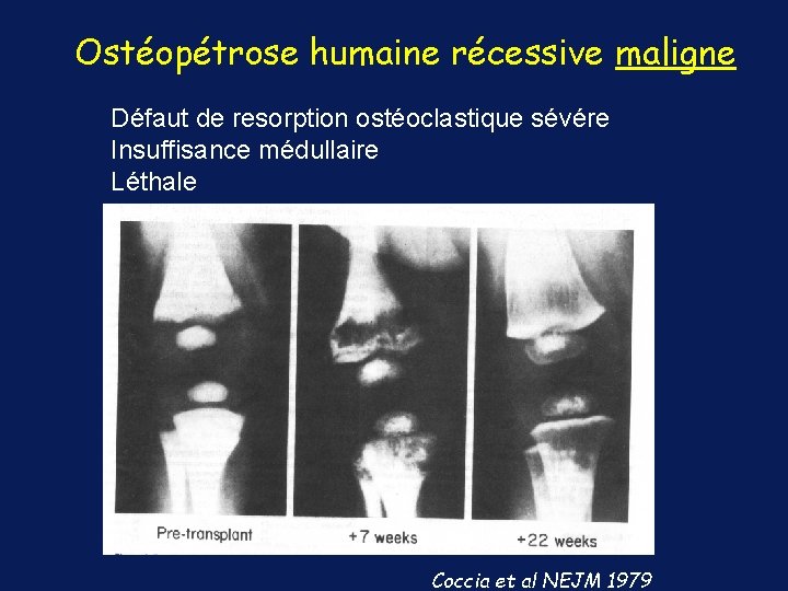 Ostéopétrose humaine récessive maligne Défaut de resorption ostéoclastique sévére Insuffisance médullaire Léthale Coccia et