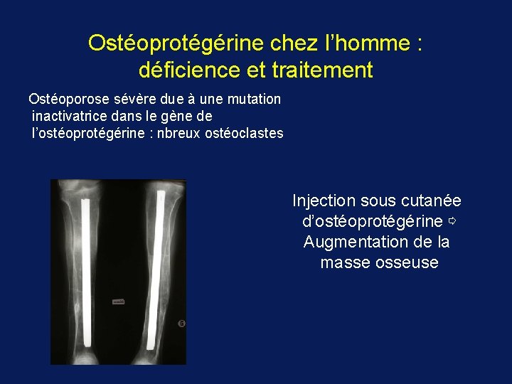 Ostéoprotégérine chez l’homme : déficience et traitement Ostéoporose sévère due à une mutation inactivatrice