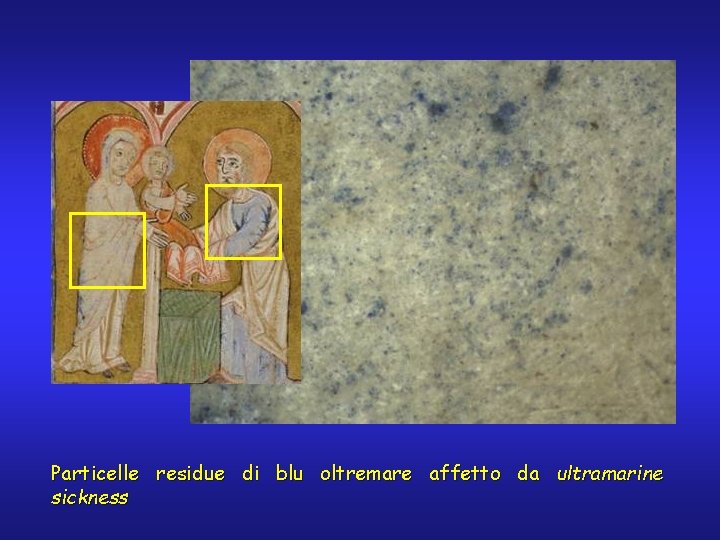 Particelle residue di blu oltremare affetto da ultramarine sickness 