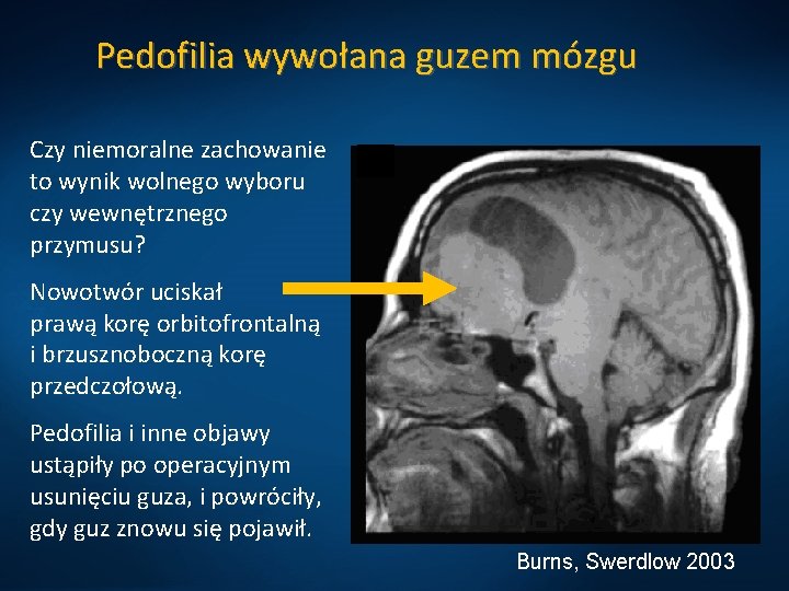 Pedofilia wywołana guzem mózgu Czy niemoralne zachowanie to wynik wolnego wyboru czy wewnętrznego przymusu?