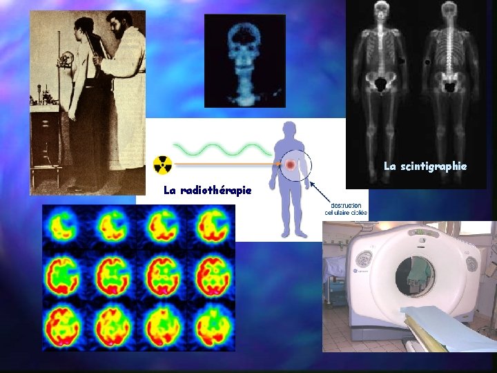 La scintigraphie La radiothérapie 