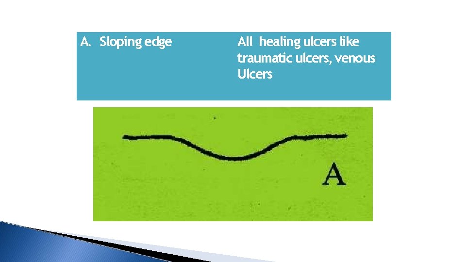 A. Sloping edge All healing ulcers like traumatic ulcers, venous Ulcers 