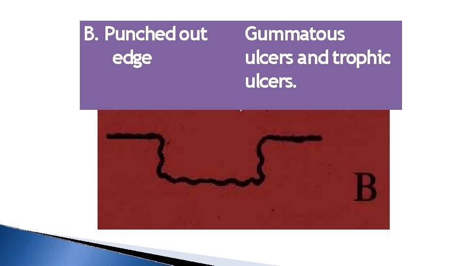 B. Punched out edge Gummatous ulcers and trophic ulcers. 