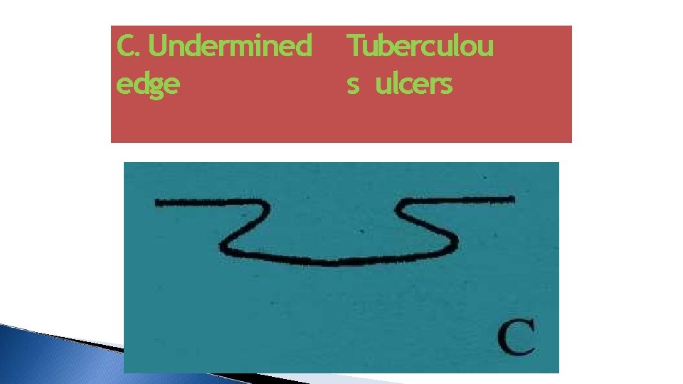 C. Undermined edge Tuberculou s ulcers 