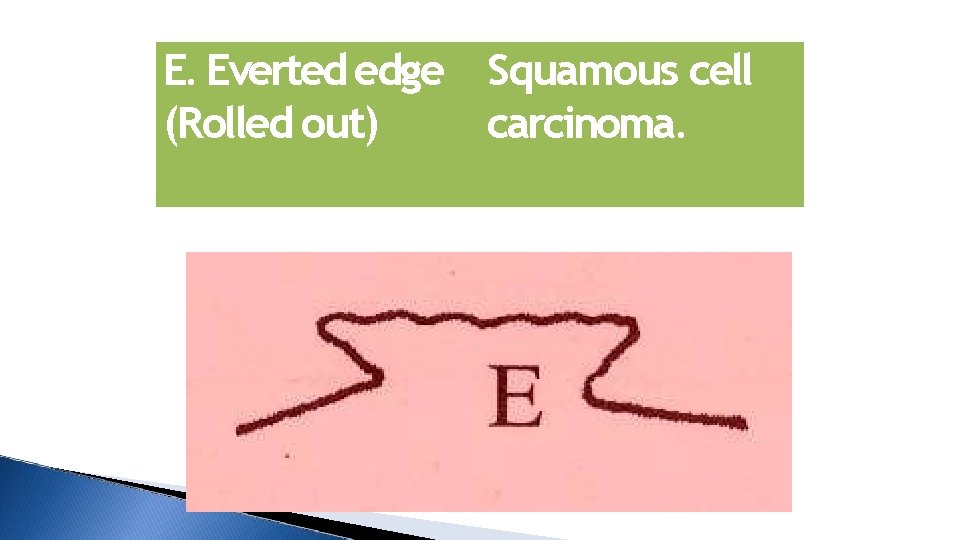 E. Everted edge Squamous cell (Rolled out) carcinoma. 