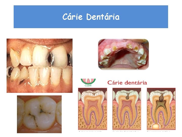 Cárie Dentária 