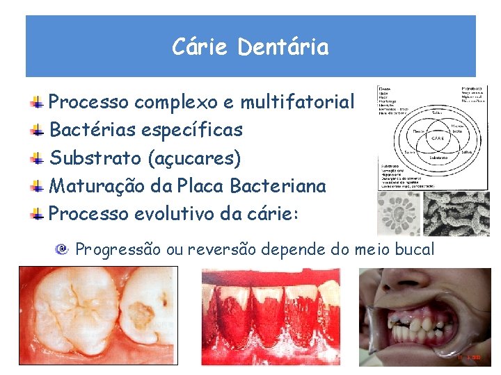 Cárie Dentária Processo complexo e multifatorial Bactérias específicas Substrato (açucares) Maturação da Placa Bacteriana