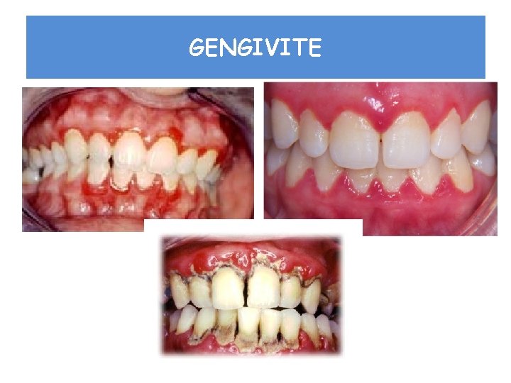 GENGIVITE GENGIVITE