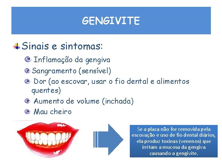 GENGIVITE Sinais e sintomas: Inflamação da gengiva Sangramento (sensível) Dor (ao escovar, usar o