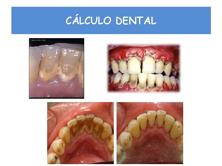 CÁLCULO DENTAL 