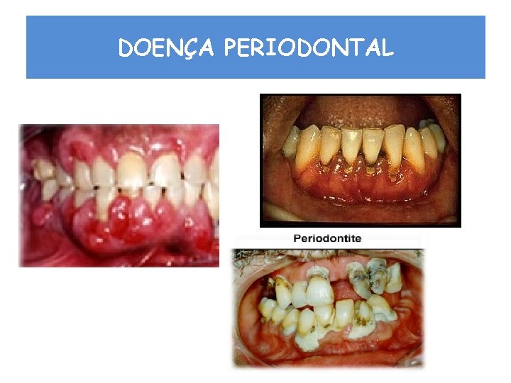 DOENÇA PERIODONTAL 