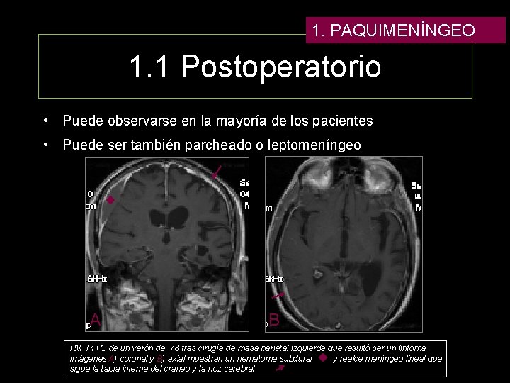 1. PAQUIMENÍNGEO 1. 1 Postoperatorio • Puede observarse en la mayoría de los pacientes