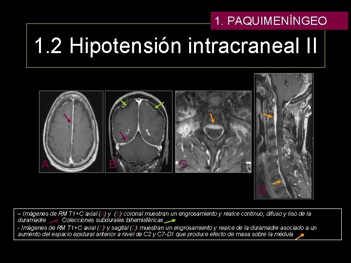 1. PAQUIMENÍNGEO 1. 2 Hipotensión intracraneal II A B C D – Imágenes de