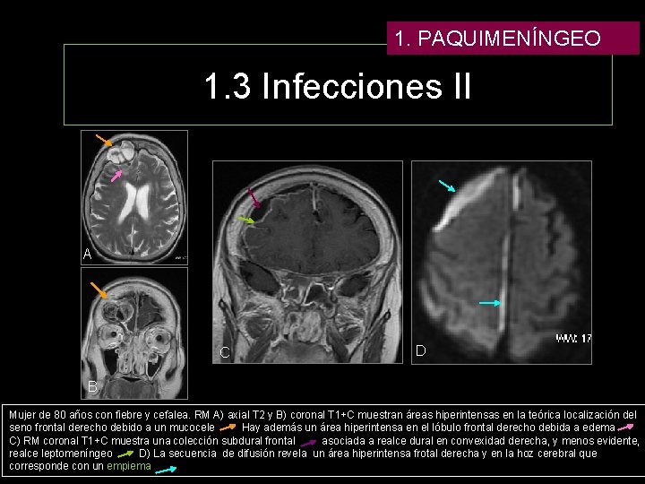 1. PAQUIMENÍNGEO 1. 3 Infecciones II A C D B Mujer de 80 años