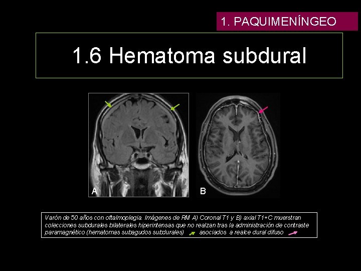 1. PAQUIMENÍNGEO 1. 6 Hematoma subdural A B Varón de 50 años con oftalmoplegia.