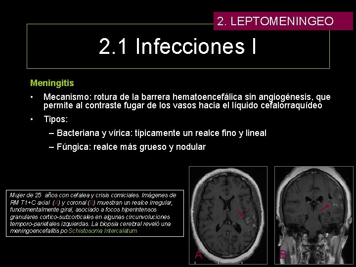 2. LEPTOMENINGEO 2. 1 Infecciones I Meningitis • Mecanismo: rotura de la barrera hematoencefálica