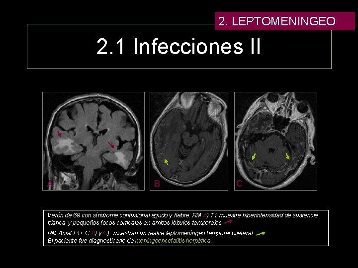 2. LEPTOMENINGEO 2. 1 Infecciones II A B C Varón de 69 con síndrome