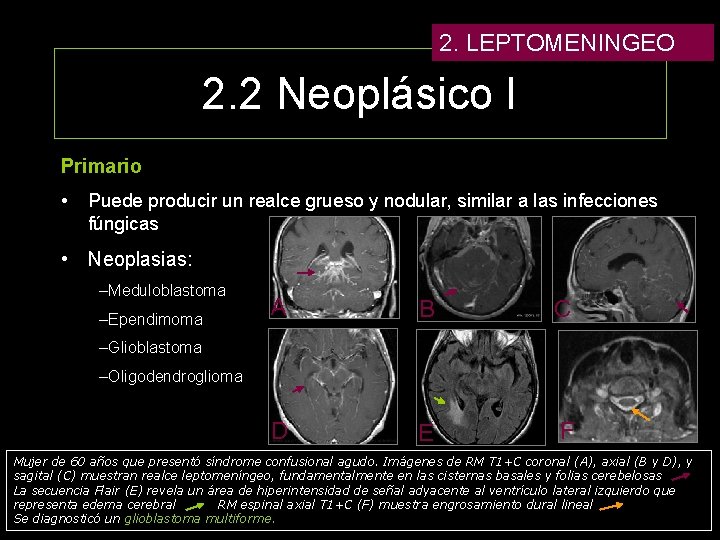 2. LEPTOMENINGEO 2. 2 Neoplásico I Primario • Puede producir un realce grueso y