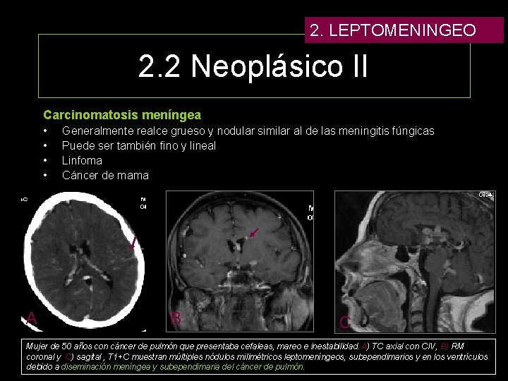 2. LEPTOMENINGEO 2. 2 Neoplásico II Carcinomatosis meníngea • • A Generalmente realce grueso