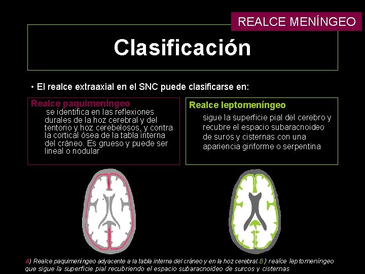 REALCE MENÍNGEO Clasificación • El realce extraaxial en el SNC puede clasificarse en: Realce REALCE MENÍNGEO Clasificación • El realce extraaxial en el SNC puede clasificarse en: Realce