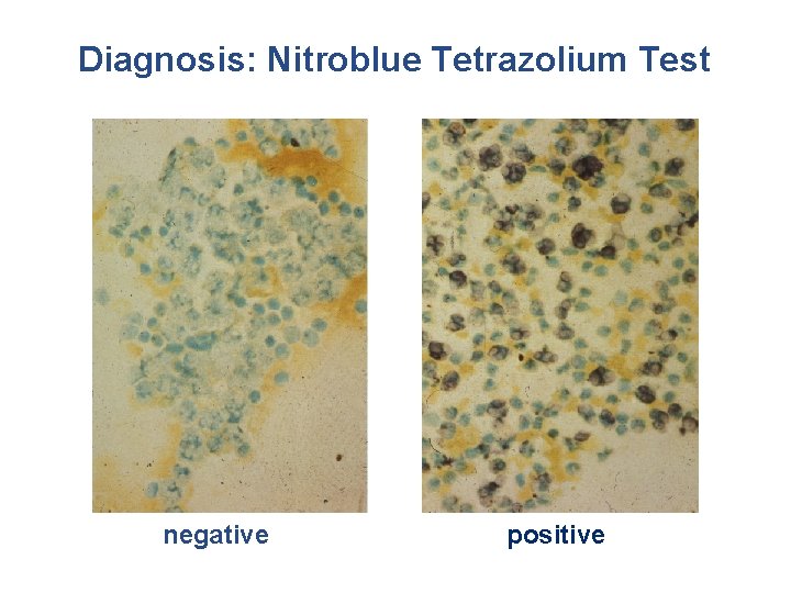 Diagnosis: Nitroblue Tetrazolium Test negative positive 