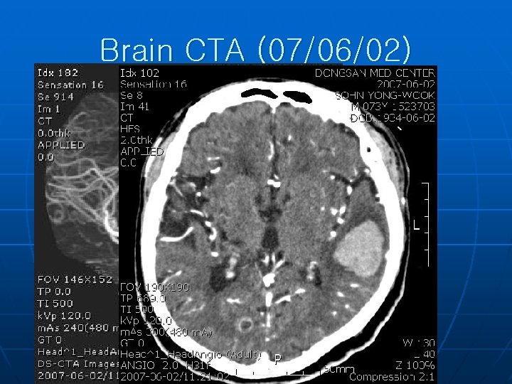 Brain CTA (07/06/02) 