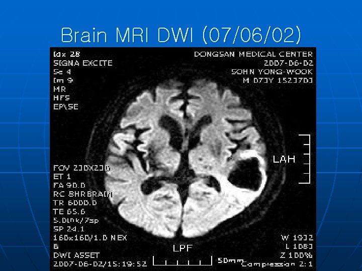 Brain MRI DWI (07/06/02) 