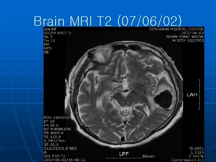 Brain MRI T 2 (07/06/02) 